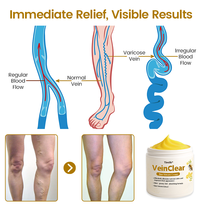 ✨Timilk® VeinClear Bee Venom Cream |✨ Visible Relief in Just 7 Days! 🦵🌿