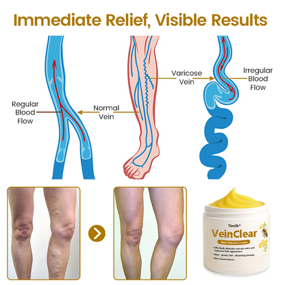 ✨Timilk® VeinClear Bee Venom Cream |✨ Visible Relief in Just 7 Days! 🦵🌿
